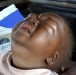 Two year old with kwashiorkor, western Zimbabwe