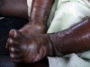 Kwashiorkor causes swelling, peeling of skin, lethargy, pitting oedema